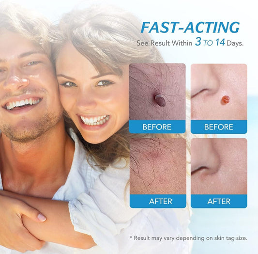 2 in 1 Skin Tag Remover Kit - Painless bqu5q7-dm